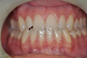 caso clinico prima dello smile design